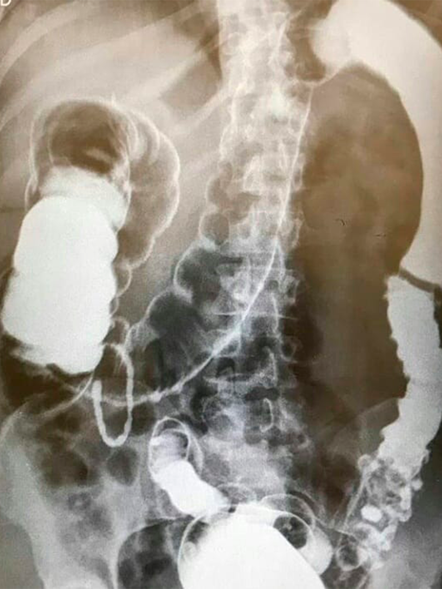 Imagem de um raio-x enema opaco